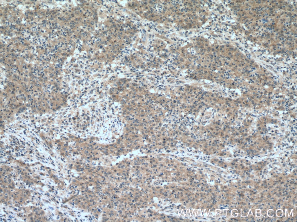 Immunohistochemistry (IHC) staining of human colon cancer tissue using BACE2 Polyclonal antibody (16321-1-AP)