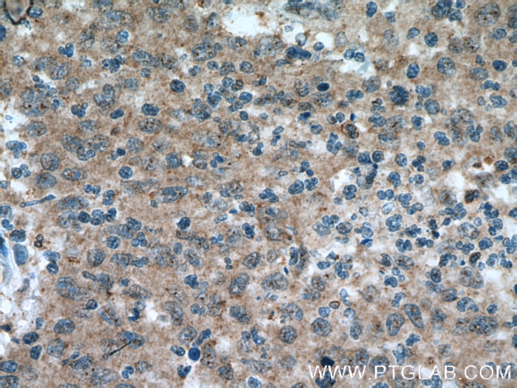 Immunohistochemistry (IHC) staining of human colon cancer tissue using BACE2 Polyclonal antibody (16321-1-AP)