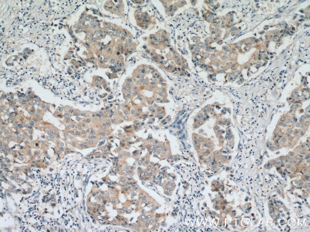 Immunohistochemistry (IHC) staining of human breast cancer tissue using BACE2 Polyclonal antibody (16321-1-AP)