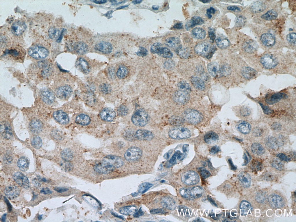 Immunohistochemistry (IHC) staining of human breast cancer tissue using BACE2 Polyclonal antibody (16321-1-AP)