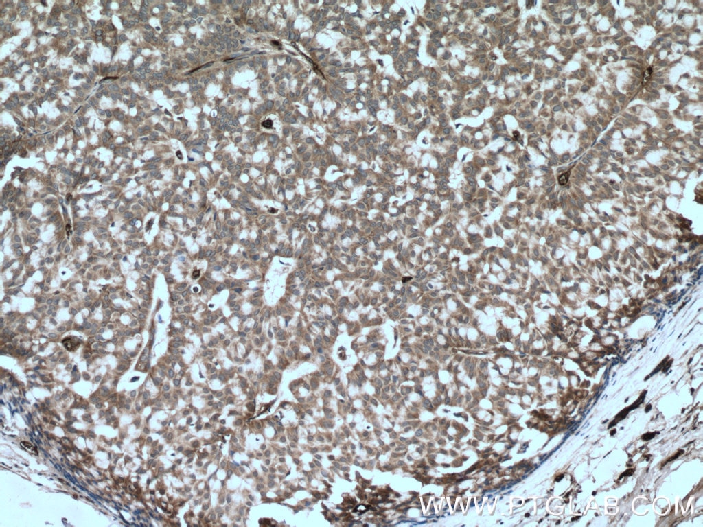 Immunohistochemistry (IHC) staining of human breast hyperplasia tissue using BACH1 Polyclonal antibody (14018-1-AP)