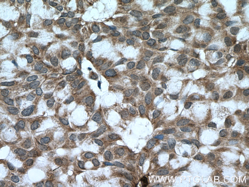 Immunohistochemistry (IHC) staining of human breast hyperplasia tissue using BACH1 Polyclonal antibody (14018-1-AP)