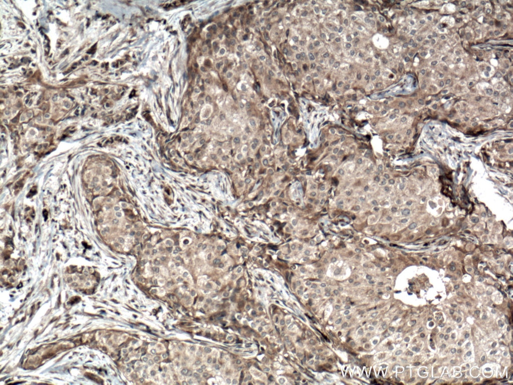 Immunohistochemistry (IHC) staining of human breast cancer tissue using BACH1 Polyclonal antibody (14018-1-AP)