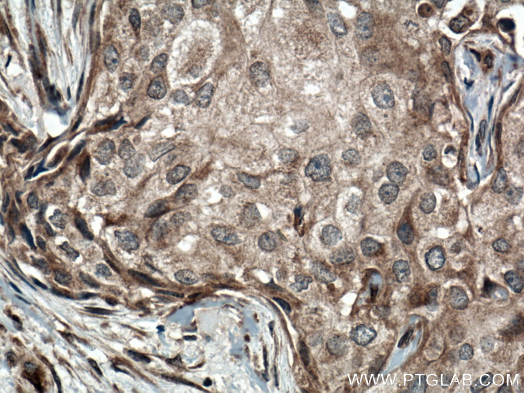Immunohistochemistry (IHC) staining of human breast cancer tissue using BACH1 Polyclonal antibody (14018-1-AP)