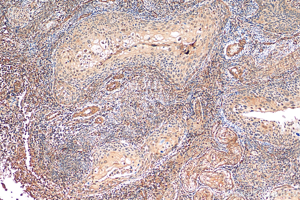 Immunohistochemistry (IHC) staining of human cervical cancer tissue using BACH1 Polyclonal antibody (14018-1-AP)
