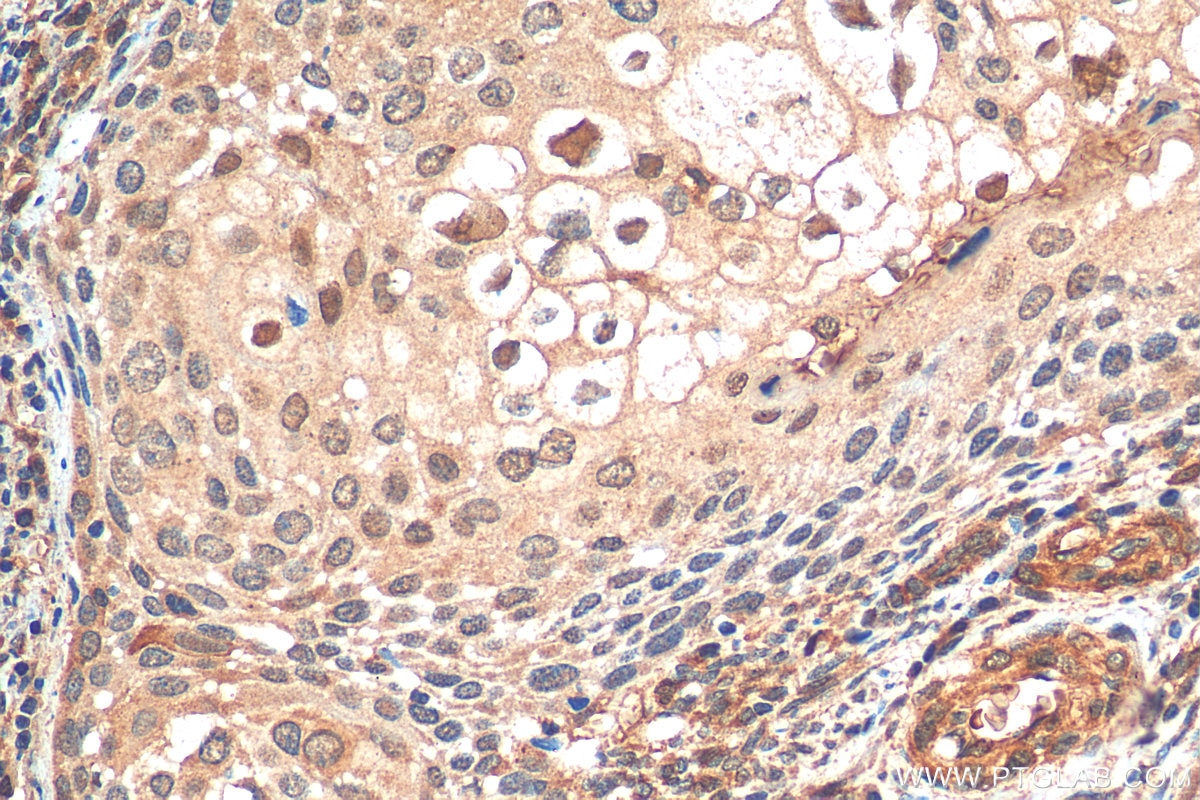 Immunohistochemistry (IHC) staining of human cervical cancer tissue using BACH1 Polyclonal antibody (14018-1-AP)