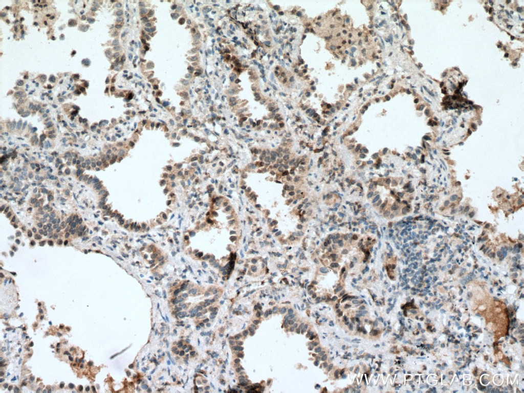 Immunohistochemistry (IHC) staining of human lung cancer tissue using BACH1 Monoclonal antibody (66762-1-Ig)