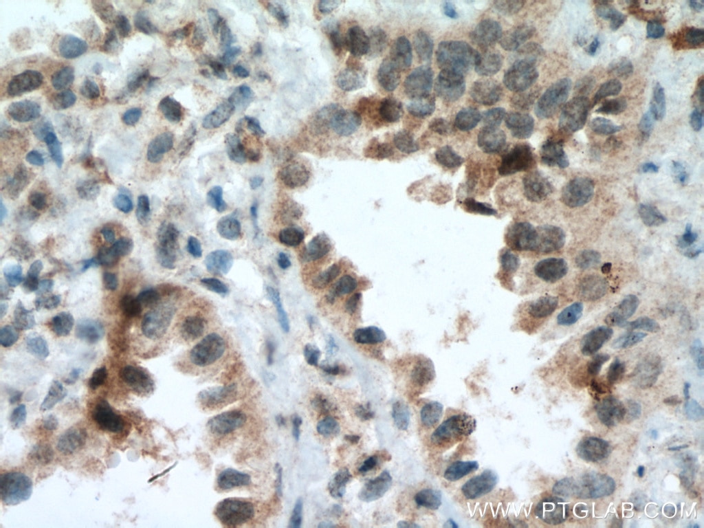 Immunohistochemistry (IHC) staining of human lung cancer tissue using BACH1 Monoclonal antibody (66762-1-Ig)