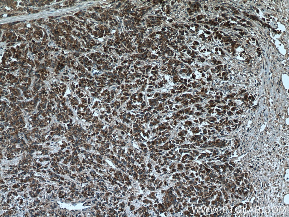 Immunohistochemistry (IHC) staining of human prostate cancer tissue using BAD Polyclonal antibody (10435-1-AP)