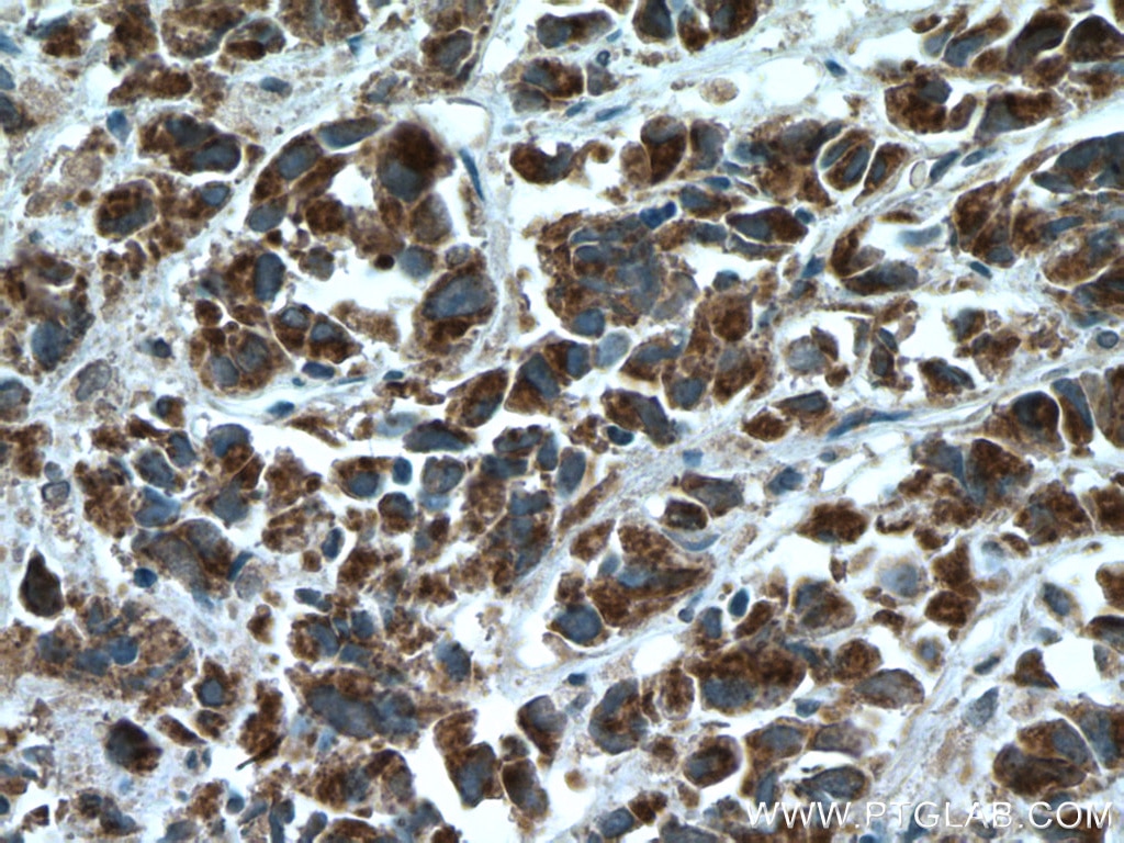 Immunohistochemistry (IHC) staining of human prostate cancer tissue using BAD Polyclonal antibody (10435-1-AP)