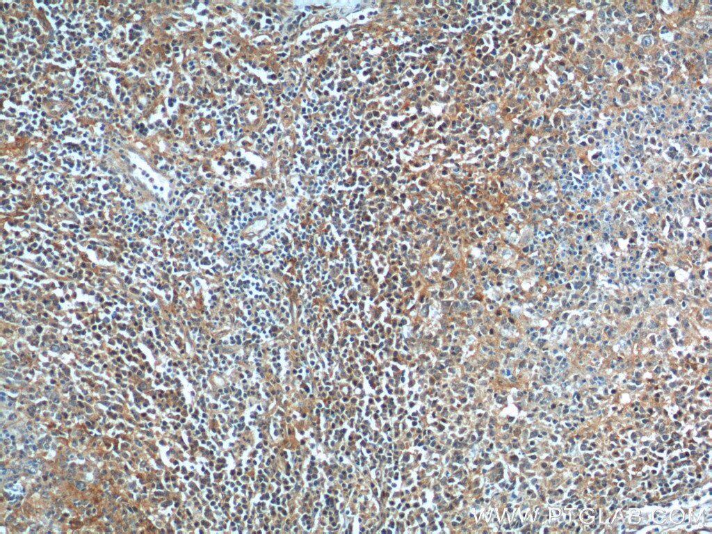 Immunohistochemistry (IHC) staining of human lymphoma tissue using BAD Polyclonal antibody (10435-1-AP)