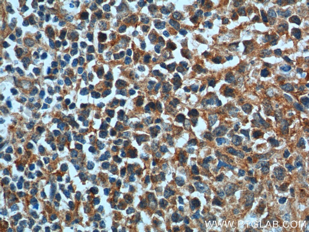Immunohistochemistry (IHC) staining of human lymphoma tissue using BAD Polyclonal antibody (10435-1-AP)