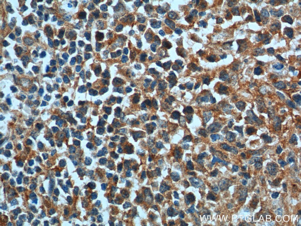 IHC staining of human lymphoma using 10435-1-AP