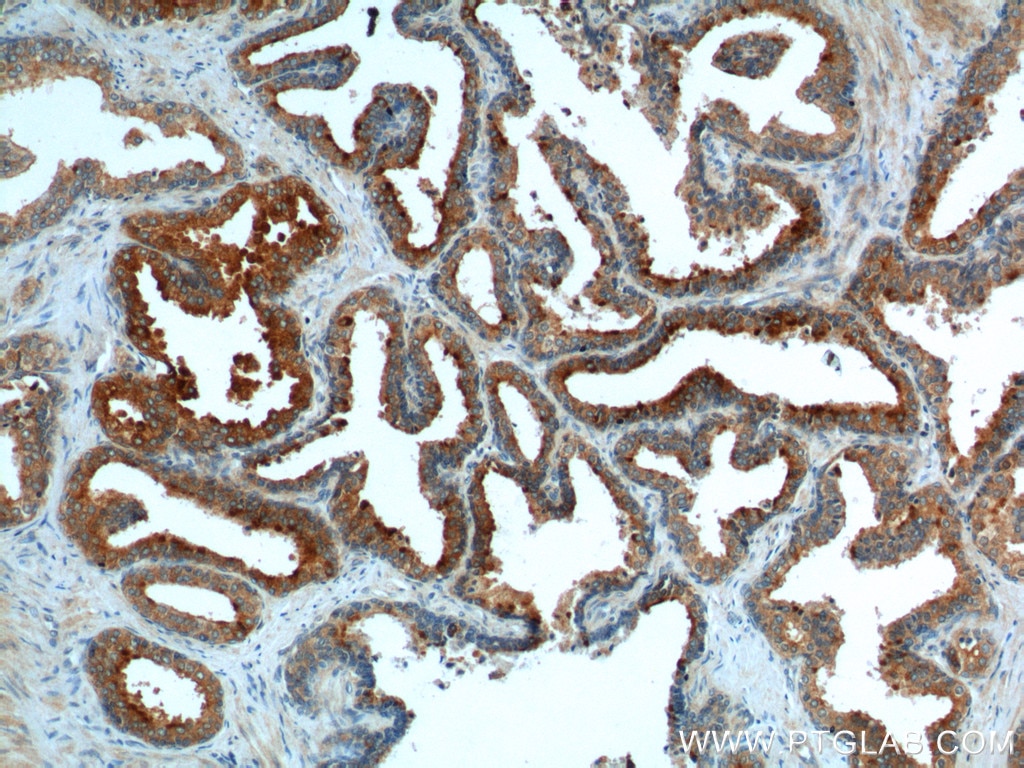 Immunohistochemistry (IHC) staining of human prostate hyperplasia tissue using BAD Polyclonal antibody (10435-1-AP)