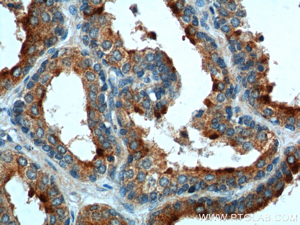 Immunohistochemistry (IHC) staining of human prostate hyperplasia tissue using BAD Polyclonal antibody (10435-1-AP)