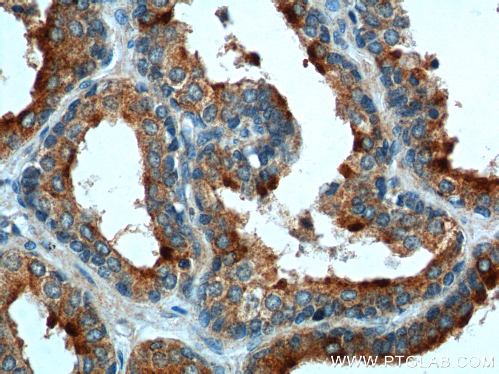 IHC staining of human prostate hyperplasia using 10435-1-AP