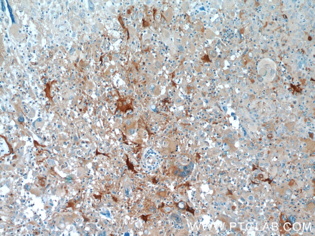 IHC staining of human gliomas using 10599-1-AP