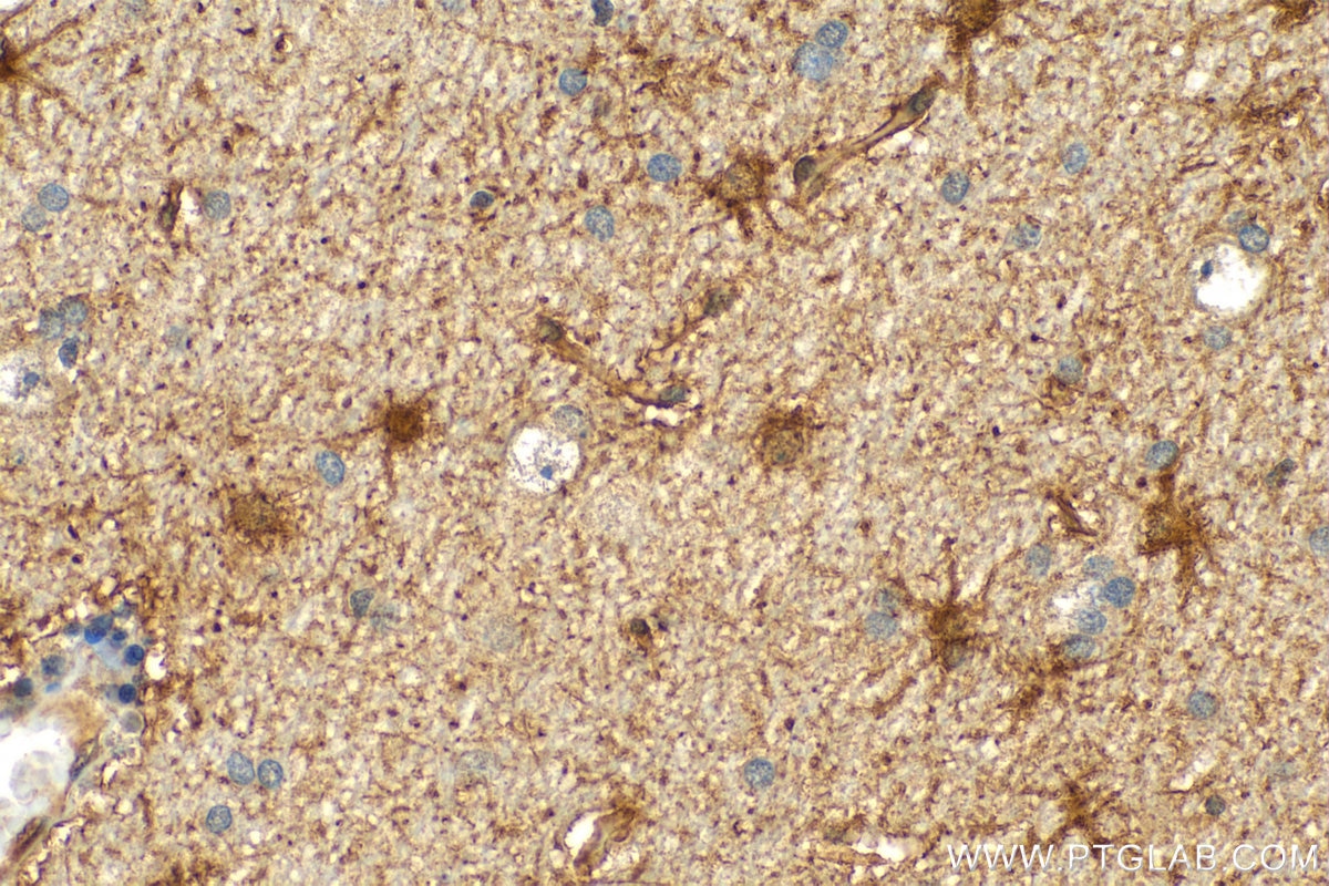 Immunohistochemistry (IHC) staining of human gliomas tissue using BAG3 Polyclonal antibody (10599-1-AP)