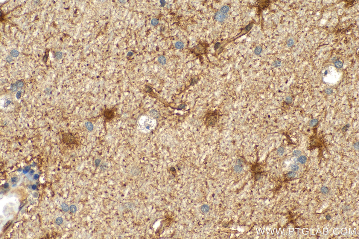 Immunohistochemistry (IHC) staining of human gliomas tissue using BAG3 Polyclonal antibody (10599-1-AP)