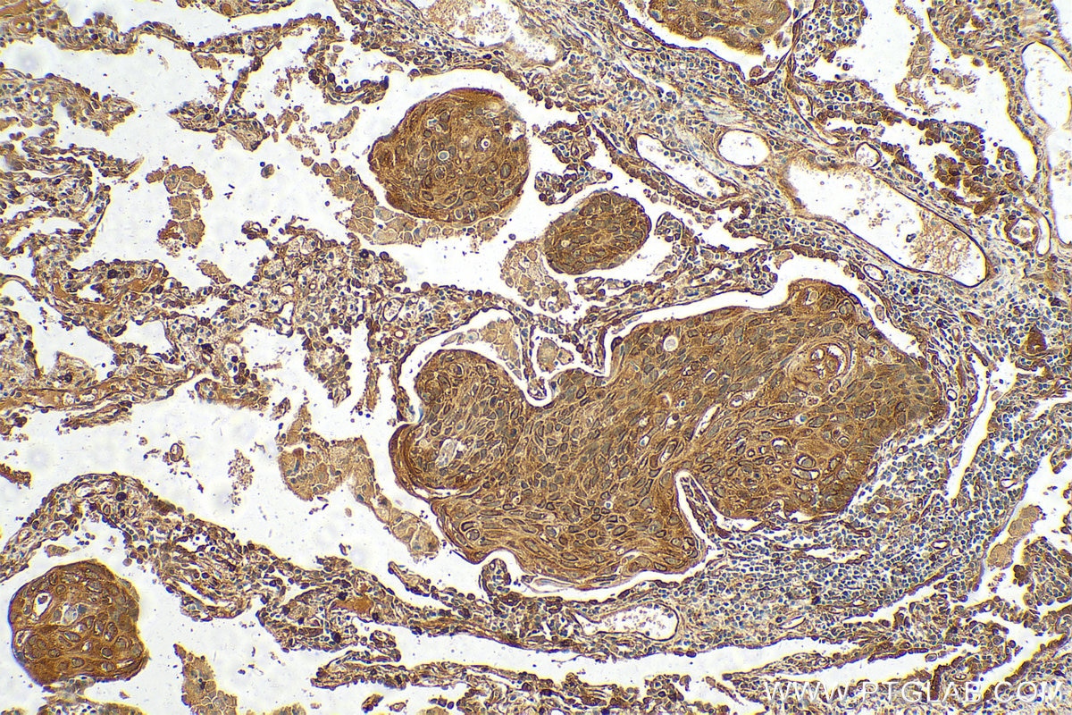 Immunohistochemistry (IHC) staining of human lung cancer tissue using BAG3 Polyclonal antibody (10599-1-AP)