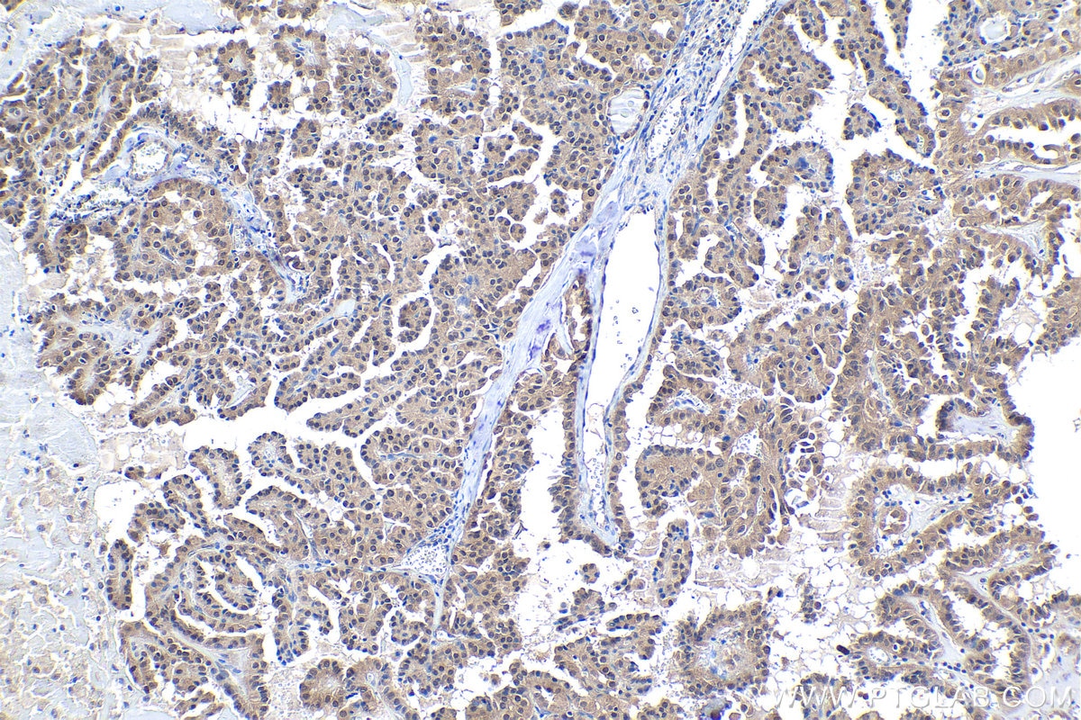 IHC staining of human thyroid cancer using 26628-1-AP