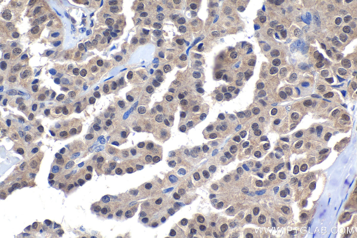 Immunohistochemistry (IHC) staining of human thyroid cancer tissue using BAG5 Polyclonal antibody (26628-1-AP)