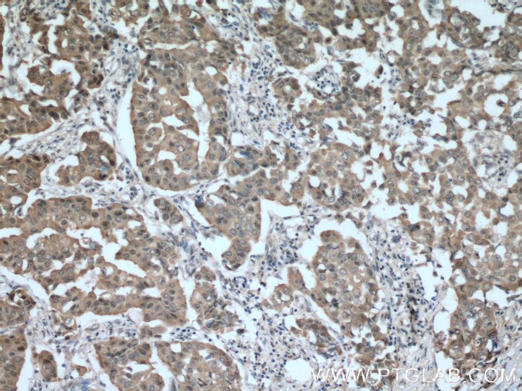 Immunohistochemistry (IHC) staining of human breast cancer tissue using BAG6 Polyclonal antibody (26417-1-AP)