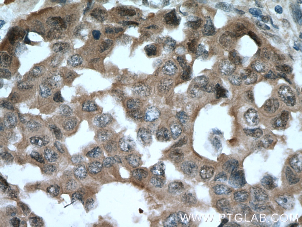 Immunohistochemistry (IHC) staining of human breast cancer tissue using BAG6 Polyclonal antibody (26417-1-AP)