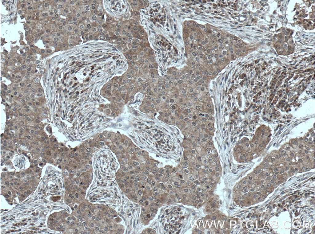 Immunohistochemistry (IHC) staining of human breast cancer tissue using BAG6 Monoclonal antibody (66661-1-Ig)