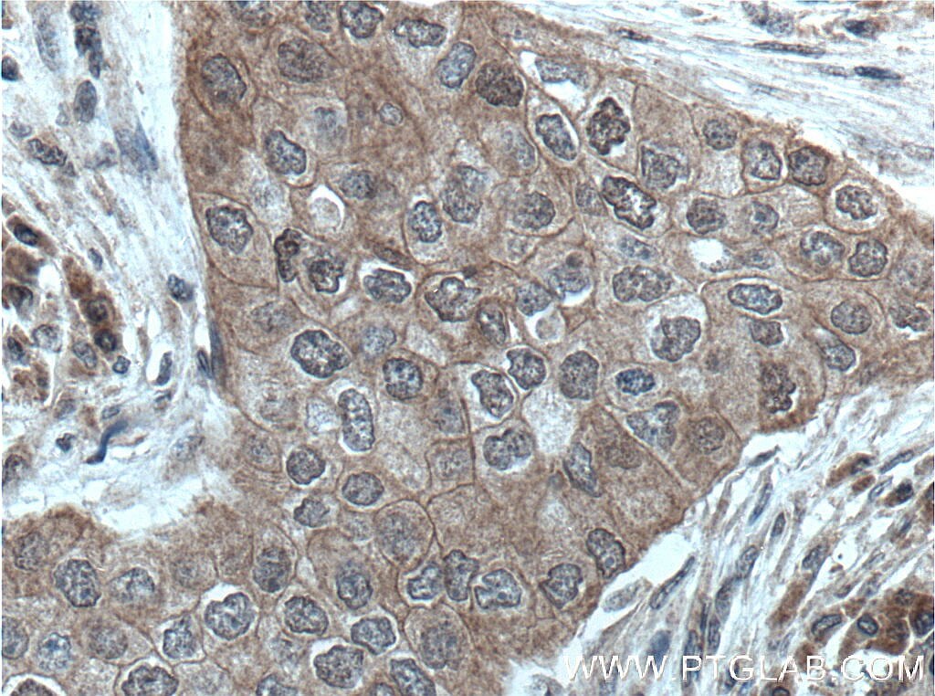Immunohistochemistry (IHC) staining of human breast cancer tissue using BAG6 Monoclonal antibody (66661-1-Ig)