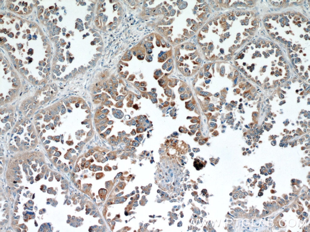 Immunohistochemistry (IHC) staining of human lung cancer tissue using BAGE4 Polyclonal antibody (20071-1-AP)
