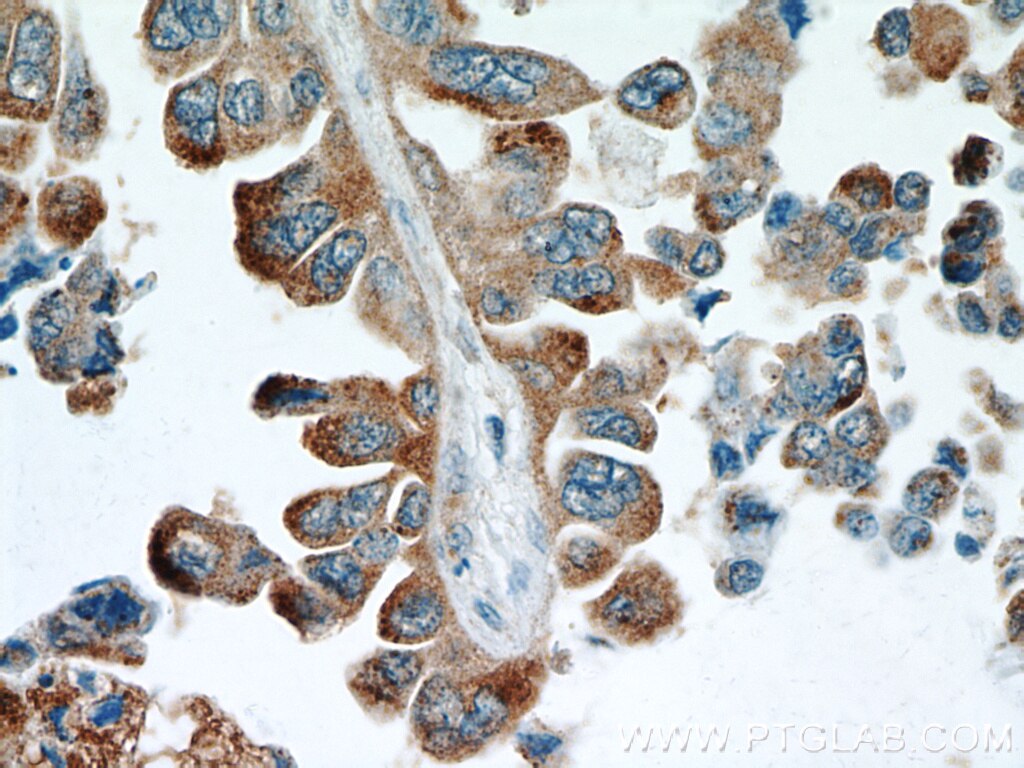 Immunohistochemistry (IHC) staining of human lung cancer tissue using BAGE4 Polyclonal antibody (20071-1-AP)