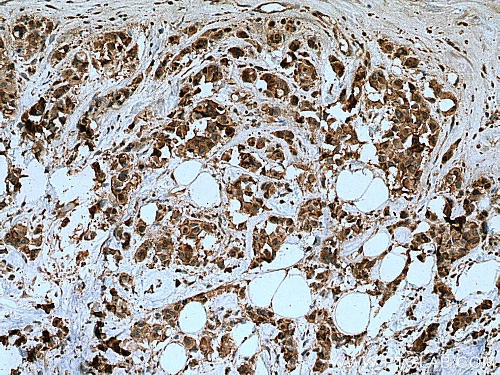 IHC staining of human breast cancer using 11087-2-AP