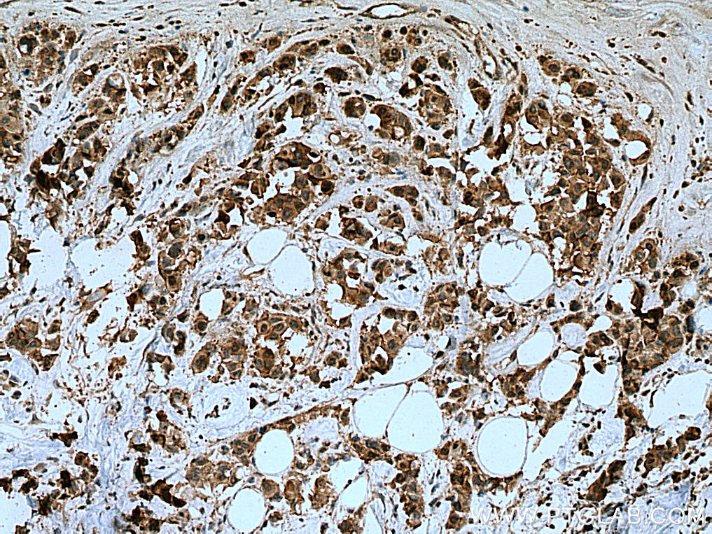 Immunohistochemistry (IHC) staining of human breast cancer tissue using IRSp53 Polyclonal antibody (11087-2-AP)