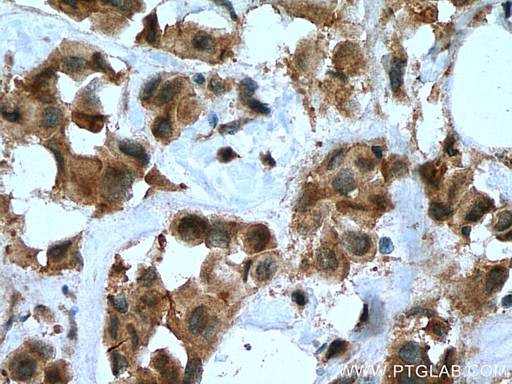Immunohistochemistry (IHC) staining of human breast cancer tissue using IRSp53 Polyclonal antibody (11087-2-AP)