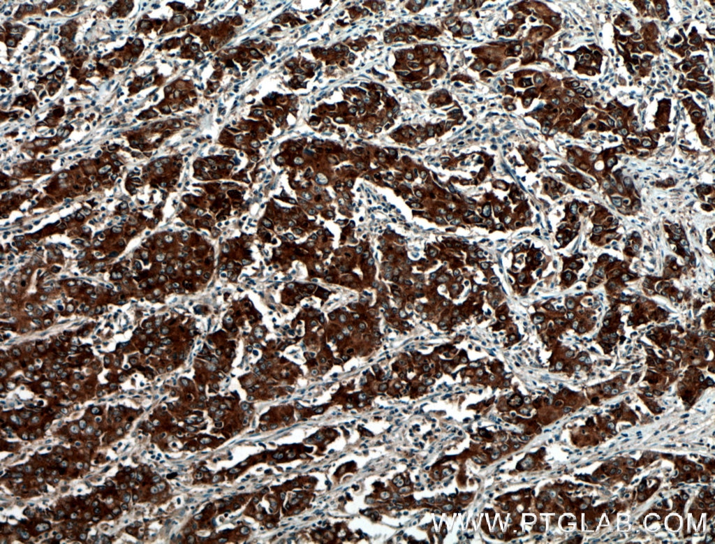 Immunohistochemistry (IHC) staining of human stomach cancer tissue using BAIAP2L1 Polyclonal antibody (25692-1-AP)