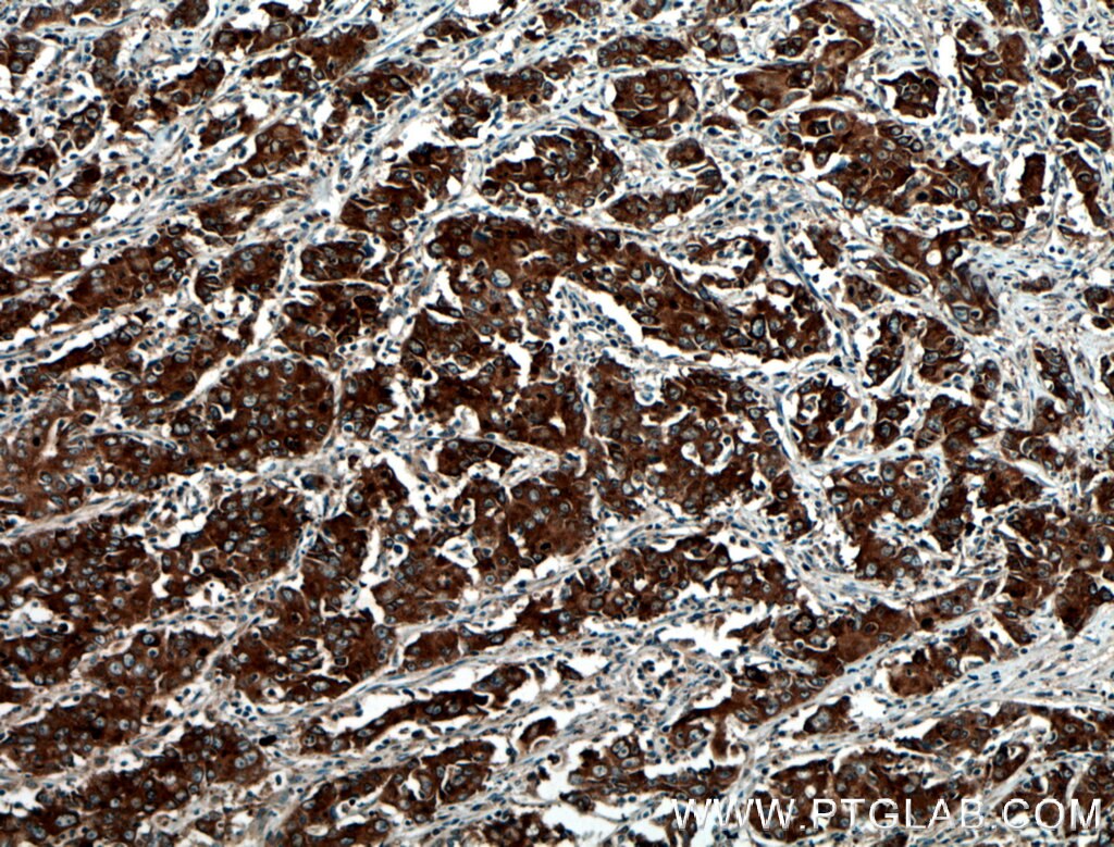 Immunohistochemistry (IHC) staining of human stomach cancer tissue using BAIAP2L1 Polyclonal antibody (25692-1-AP)