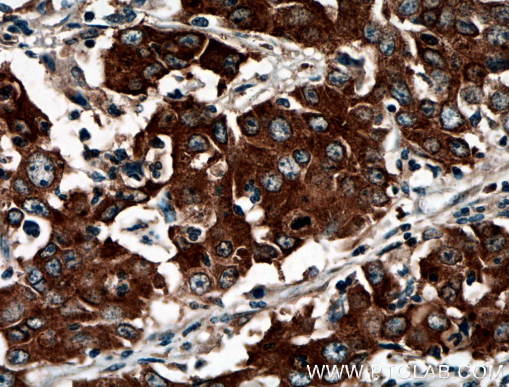 Immunohistochemistry (IHC) staining of human stomach cancer tissue using BAIAP2L1 Polyclonal antibody (25692-1-AP)