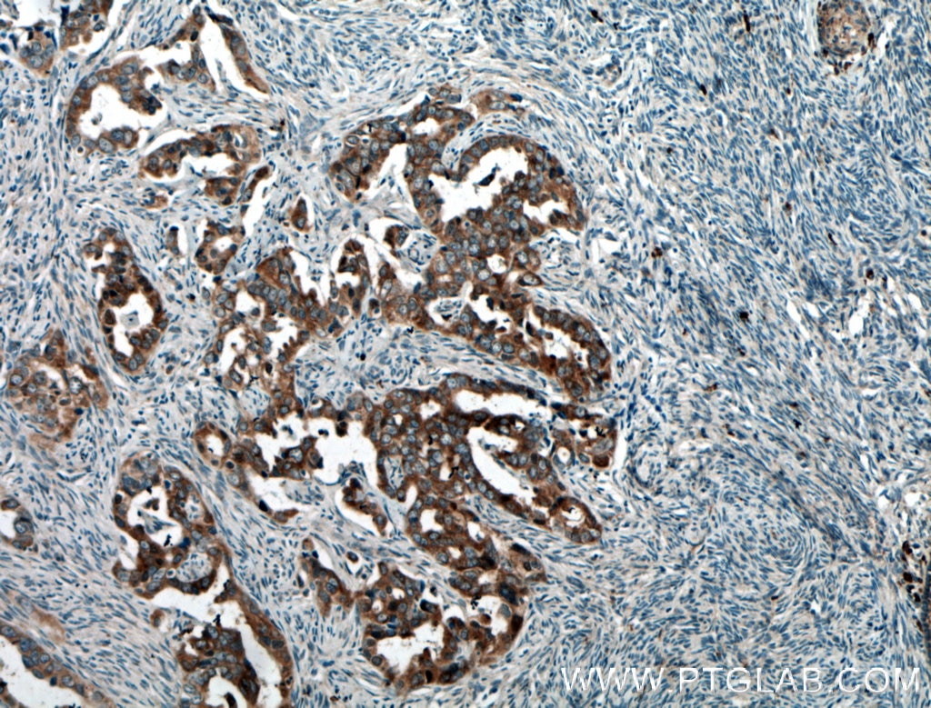 IHC staining of human ovary tumor using 25692-1-AP