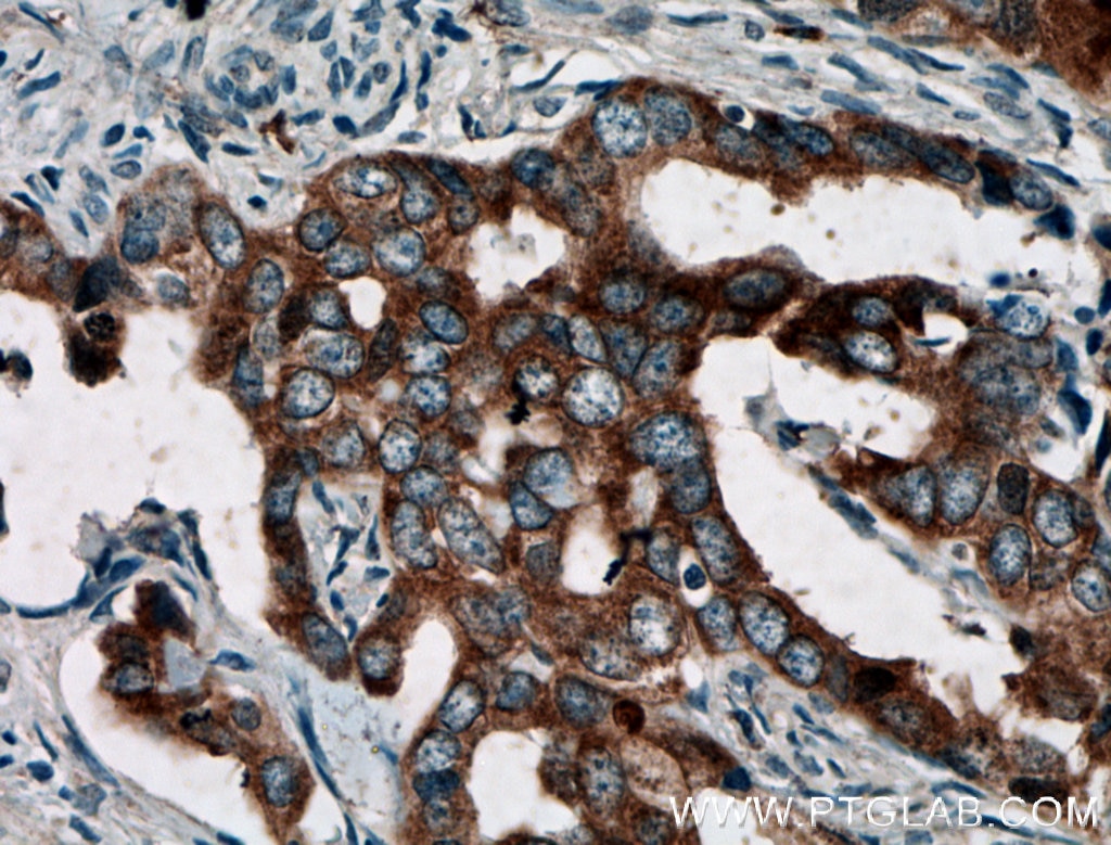 Immunohistochemistry (IHC) staining of human ovary tumor tissue using BAIAP2L1 Polyclonal antibody (25692-1-AP)