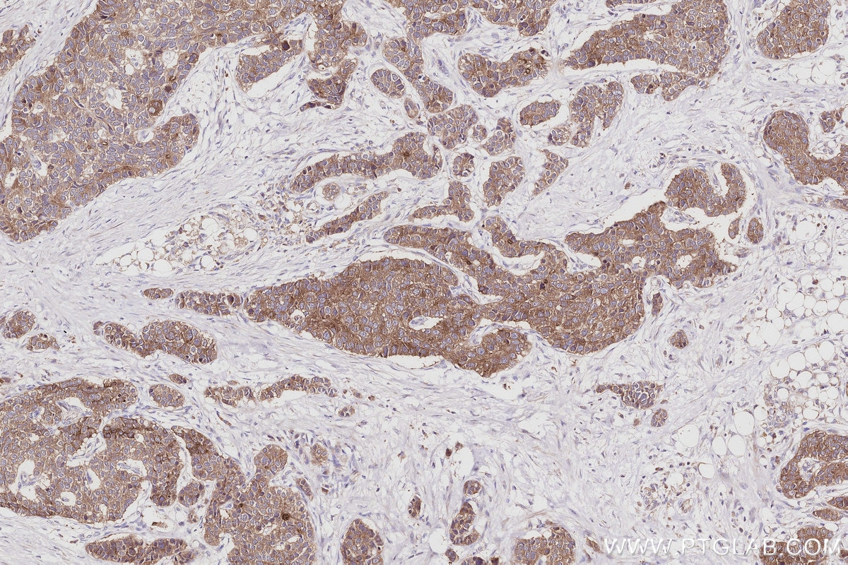 Immunohistochemistry (IHC) staining of human stomach cancer tissue using BAIAP2L1 Polyclonal antibody (25692-1-AP)