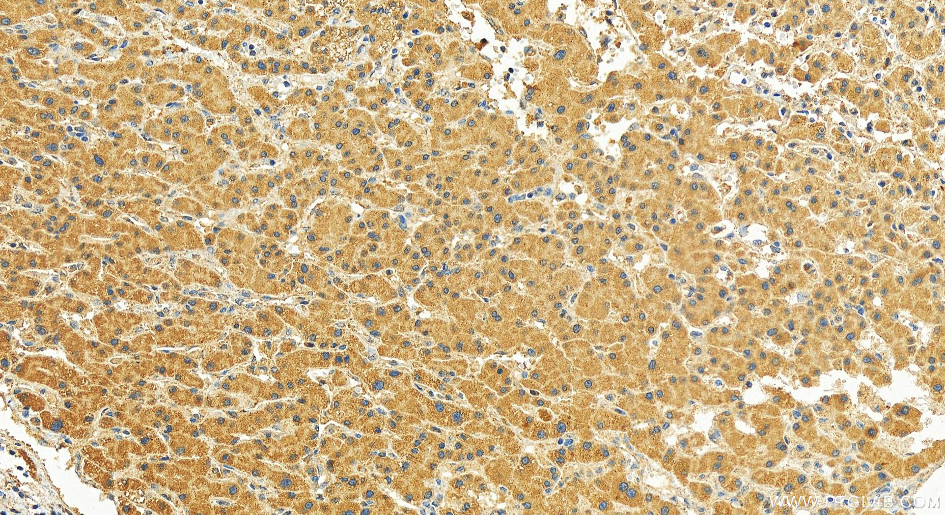 Immunohistochemistry (IHC) staining of human intrahepatic cholangiocarcinoma tissue using BAIAP2L2 Polyclonal antibody (16738-1-AP)