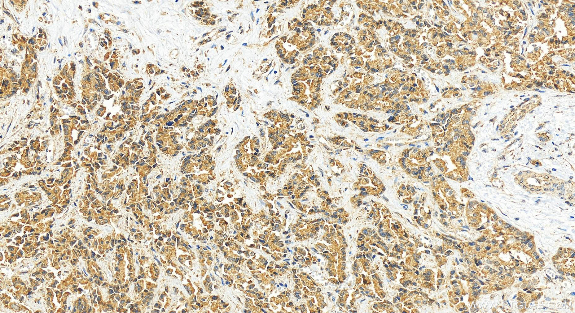Immunohistochemistry (IHC) staining of human intrahepatic cholangiocarcinoma tissue using BAIAP2L2 Polyclonal antibody (16738-1-AP)