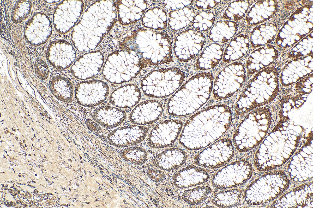 Immunohistochemistry (IHC) staining of human colon cancer tissue using BAK Polyclonal antibody (29552-1-AP)