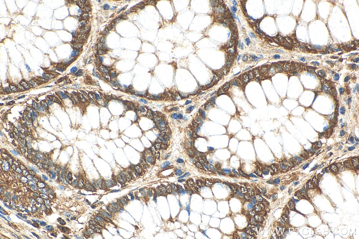 Immunohistochemistry (IHC) staining of human colon cancer tissue using BAK Polyclonal antibody (29552-1-AP)