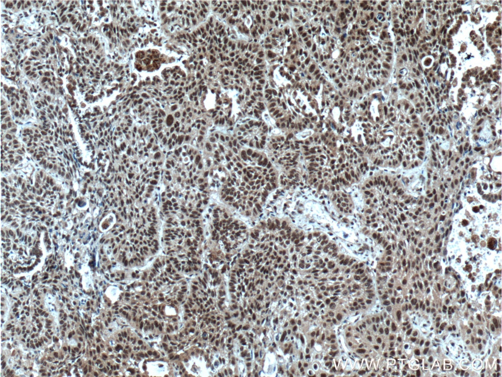 IHC staining of human lung cancer using 16393-1-AP
