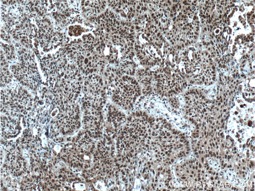 Immunohistochemistry (IHC) staining of human lung cancer tissue using BANP Polyclonal antibody (16393-1-AP)