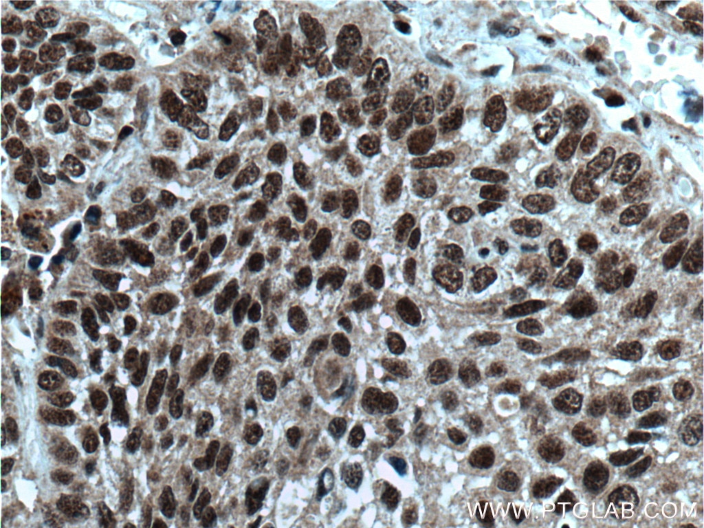 Immunohistochemistry (IHC) staining of human lung cancer tissue using BANP Polyclonal antibody (16393-1-AP)