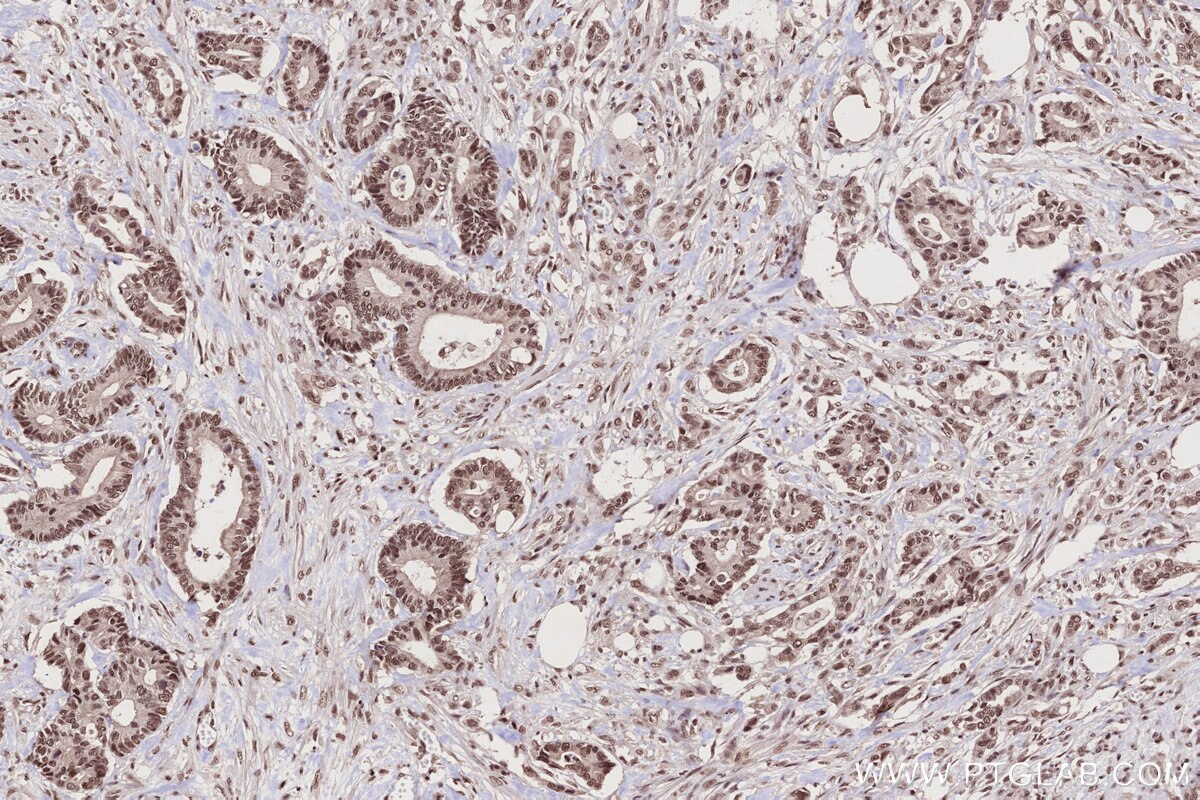 Immunohistochemistry (IHC) staining of human rectal cancer tissue using BANP Polyclonal antibody (16393-1-AP)