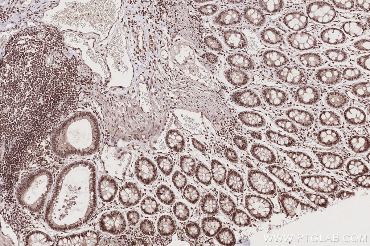 Immunohistochemistry (IHC) staining of human rectal cancer tissue using BANP Polyclonal antibody (16393-1-AP)